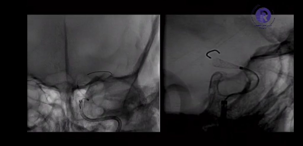 Renal AVF Embolization