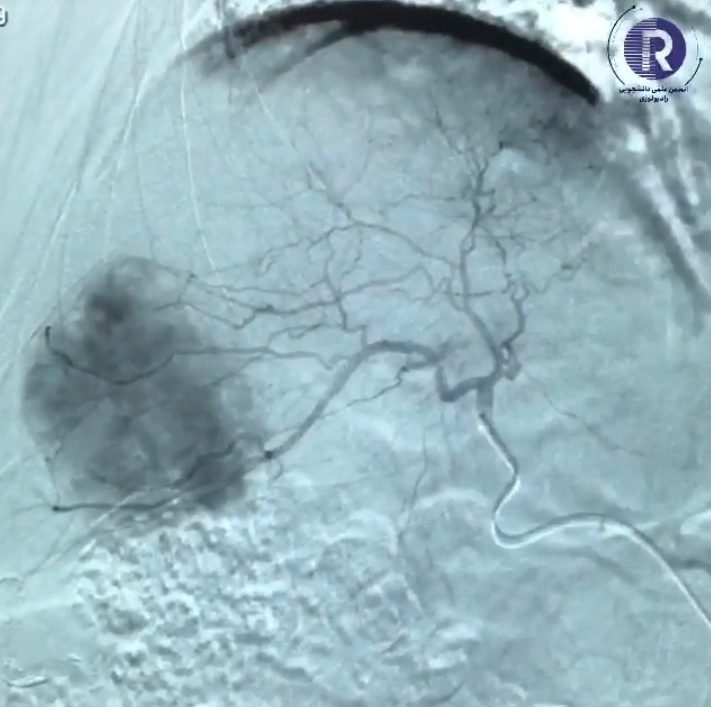 Trans-catheter Arterial Chemoembolization