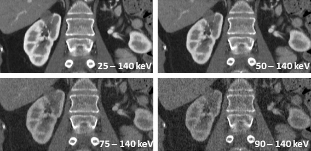 Photon-counting CT will replace current CT detector technology