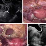 Postoperative Imaging of Endometriosis