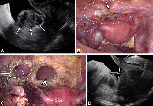 Postoperative Imaging of Endometriosis